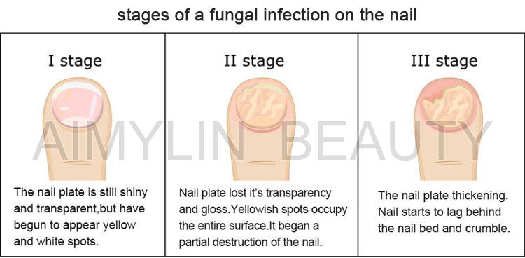 nail fungus treatment