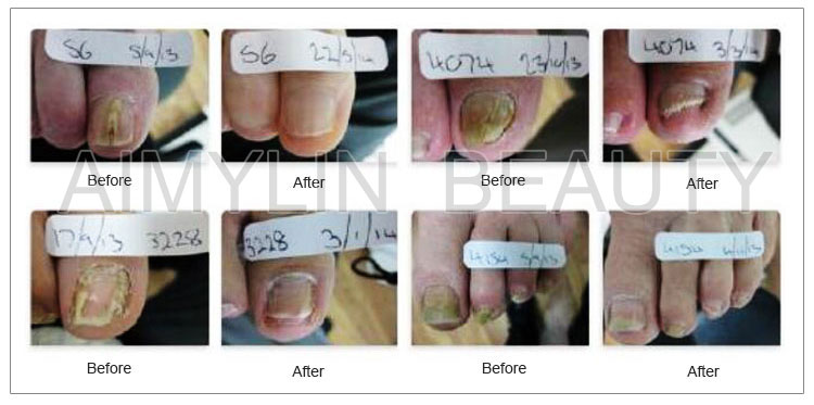 nail fungus before and after